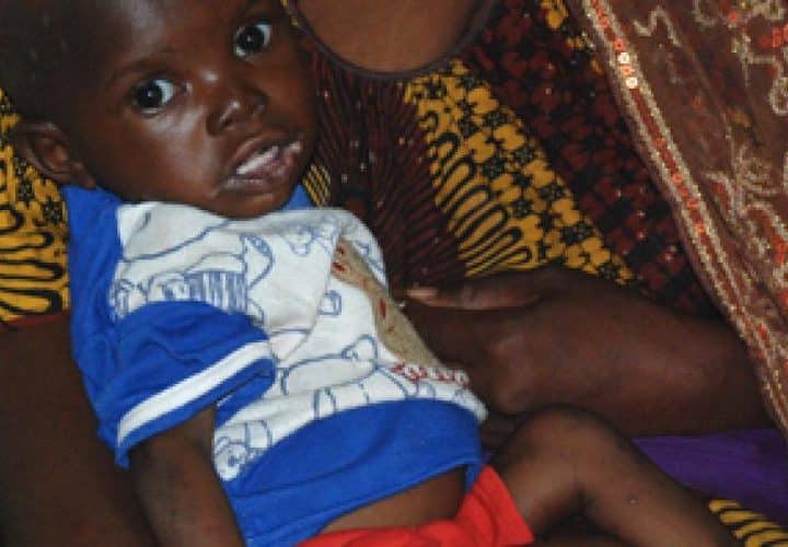 Enfant touché par la malnutrition au Mali